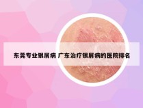 东莞专业银屑病 广东治疗银屑病的医院排名
