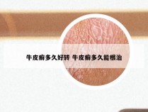 牛皮癣多久好转 牛皮癣多久能根治