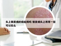 头上银屑病的痂能揭吗 银屑病头上厚厚一层可以扣么