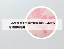 uvb光疗是怎么治疗银屑病的 uvb灯治疗银屑病周期