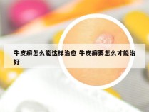 牛皮癣怎么能这样治愈 牛皮癣要怎么才能治好