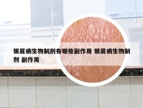 银屑病生物制剂有哪些副作用 银屑病生物制剂 副作用