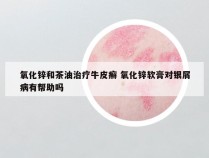 氧化锌和茶油治疗牛皮癣 氧化锌软膏对银屑病有帮助吗
