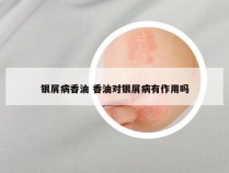 银屑病香油 香油对银屑病有作用吗