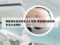 银屑病头部皮屑多怎么处理 银屑病头部皮屑多怎么处理好