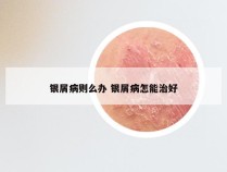 银屑病则么办 银屑病怎能治好