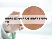 银屑病能偶尔吃牛肉丸吗 银屑病可不可以吃牛肉