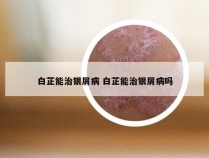 白芷能治银屑病 白芷能治银屑病吗