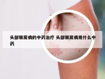 头部银屑病的中药治疗 头部银屑病用什么中药