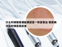 什么时候银屑病能跟感冒一样容易治 银屑病什么时候容易反复