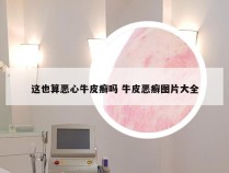 这也算恶心牛皮癣吗 牛皮恶癣图片大全