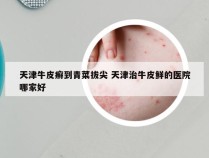 天津牛皮癣到青菜拔尖 天津治牛皮鲜的医院哪家好