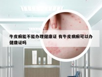 牛皮癣能不能办理健康证 有牛皮病癣可以办健康证吗
