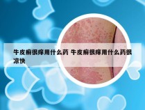 牛皮癣很痒用什么药 牛皮癣很痒用什么药很凉快