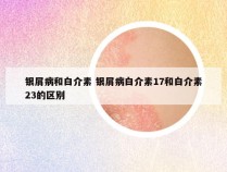 银屑病和白介素 银屑病白介素17和白介素23的区别