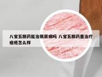 八宝五胆药能治银屑病吗 八宝五胆药墨治疗痤疮怎么样