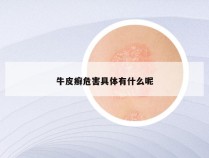 牛皮癣危害具体有什么呢