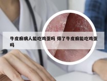 牛皮癣病人能吃鸡蛋吗 得了牛皮癣能吃鸡蛋吗