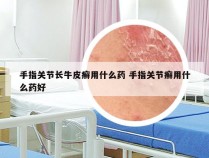 手指关节长牛皮癣用什么药 手指关节癣用什么药好