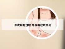 牛皮癣与过敏 牛皮癣过敏图片