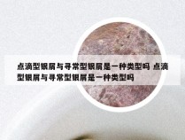 点滴型银屑与寻常型银屑是一种类型吗 点滴型银屑与寻常型银屑是一种类型吗
