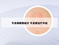 牛皮癣断根秘方 牛皮癣治疗手段
