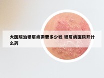 大医院治银屑病需要多少钱 银屑病医院开什么药