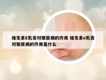 维生素E乳膏对银屑病的作用 维生素e乳膏对银屑病的作用是什么