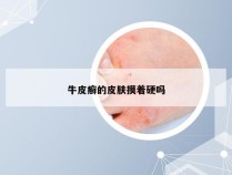 牛皮癣的皮肤摸着硬吗