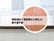 银屑病il23 银屑病IL23和IL22哪个更严重