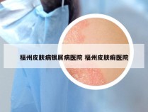 福州皮肤病银屑病医院 福州皮肤癣医院