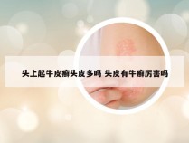 头上起牛皮癣头皮多吗 头皮有牛癣厉害吗
