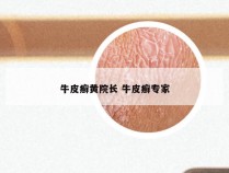牛皮癣黄院长 牛皮癣专家