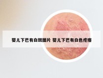 婴儿下巴有白斑图片 婴儿下巴有白色疙瘩