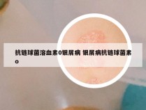 抗链球菌溶血素0银屑病 银屑病抗链球菌素o