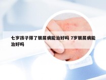 七岁孩子得了银屑病能治好吗 7岁银屑病能治好吗