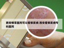 西安哪家医院可以看银屑病 西安看银屑病专科医院