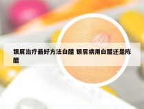 银屑治疗最好方法白醋 银屑病用白醋还是陈醋