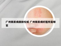 广州银屑病康肤权威 广州银屑病好医院是哪家
