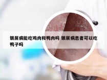 银屑病能吃鸡肉和鸭肉吗 银屑病患者可以吃鸭子吗