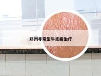 郑州寻常型牛皮癣治疗