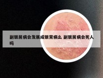 副银屑病会发展成银霄病么 副银屑病会死人吗