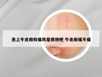患上牛皮癣和痛风是很惨吧 牛皮癣痛不痛