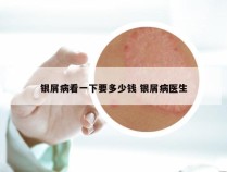银屑病看一下要多少钱 银屑病医生