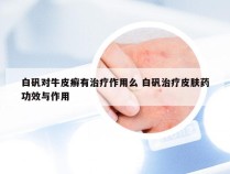 白矾对牛皮癣有治疗作用么 白矾治疗皮肤药功效与作用