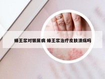 蜂王浆对银屑病 蜂王浆治疗皮肤溃疡吗
