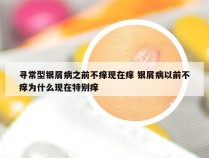 寻常型银屑病之前不痒现在痒 银屑病以前不痒为什么现在特别痒