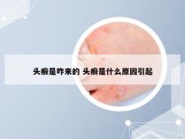 头癣是咋来的 头癣是什么原因引起