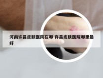 河南许昌皮肤医院在哪 许昌皮肤医院哪里最好