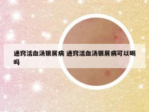 通窍活血汤银屑病 通窍活血汤银屑病可以喝吗